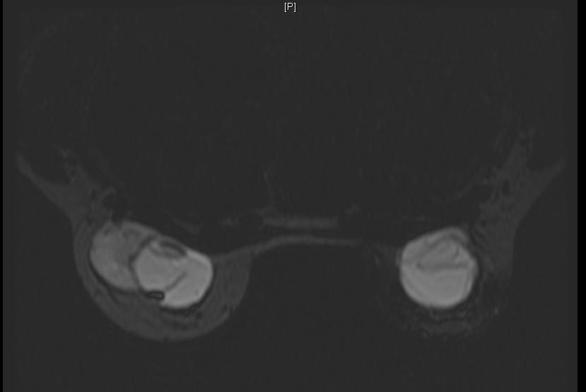 Breast MRI: Intra and extracapsular rupture