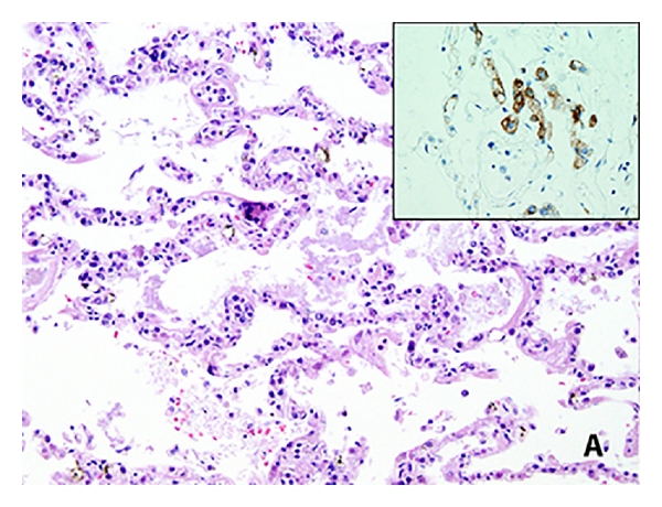 File:Intravascular large b-cell lymphoma patology image 1 .jpg