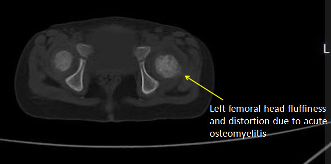 Left Femoral head osteomyelitis