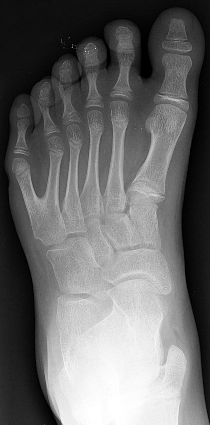 Left foot with postaxial polydactyly of 5th ray
