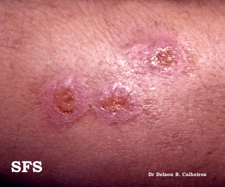 Gummatous lesions in tertiary syphilis - Adapted from Dermatology Atlas.[4]