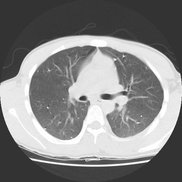 File:Varicella Pneumonia CT - 2.jpg