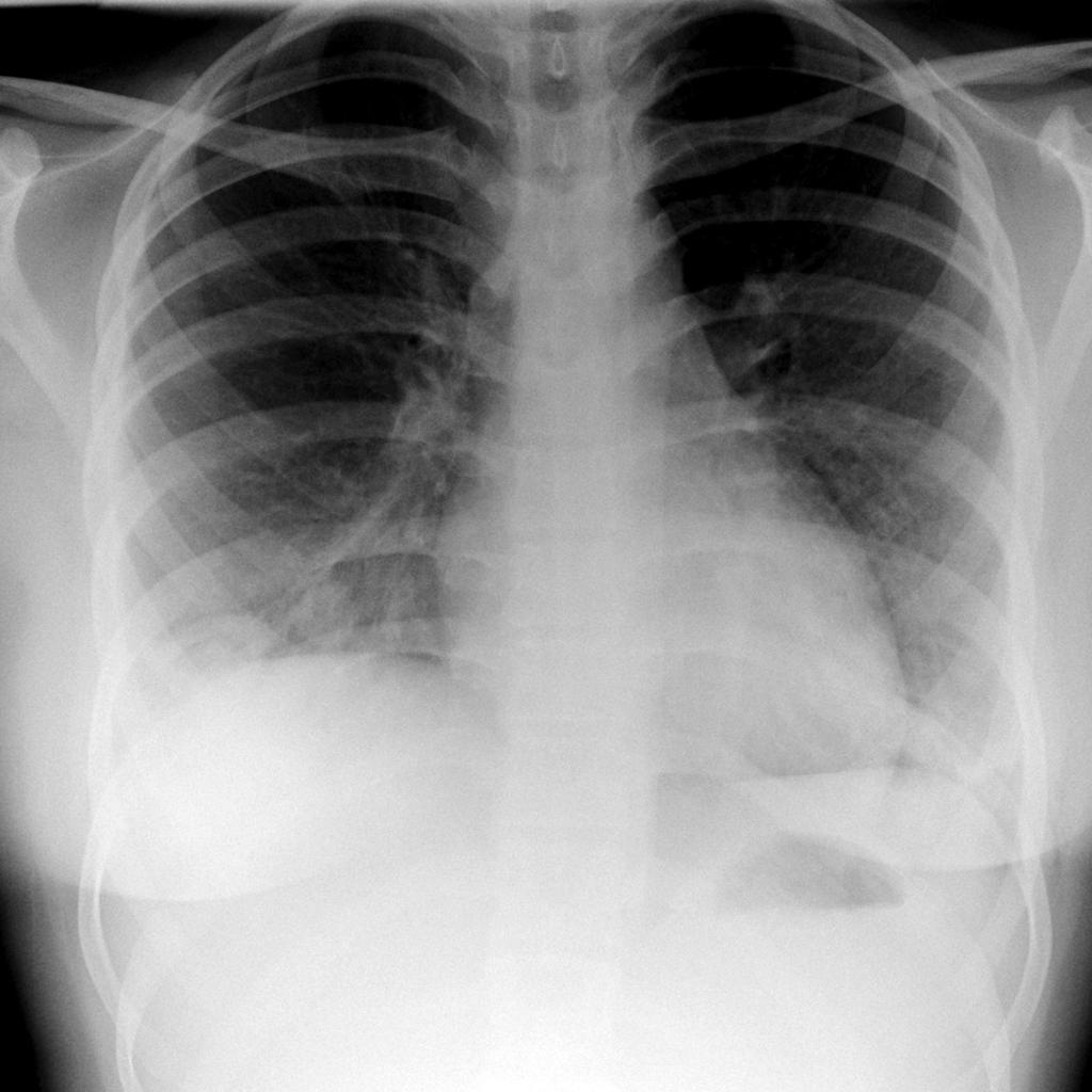 Granulomatosis with polyangiitis- X ray PA view showing air opacities Source:Radiopaedia.org[1]