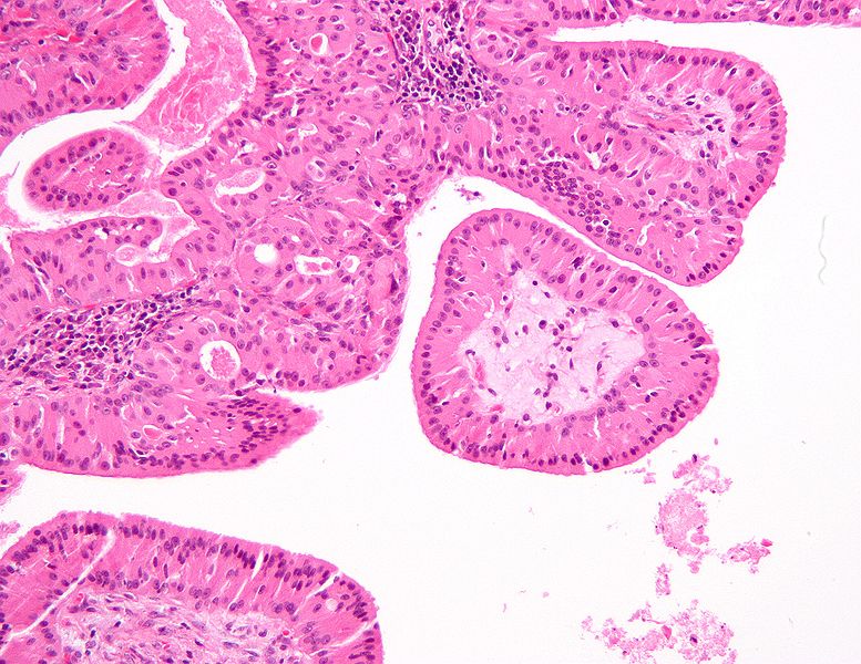 Histopathology of Warthin tumor in the parotid gland. Image courtesy of Nephron librepathology (original file ‘’here’’). Creative Commons BY­SA­NC