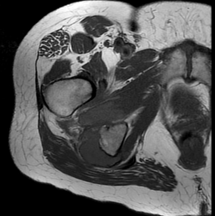File:Hamstring tendon avulsion MRI 001.jpg