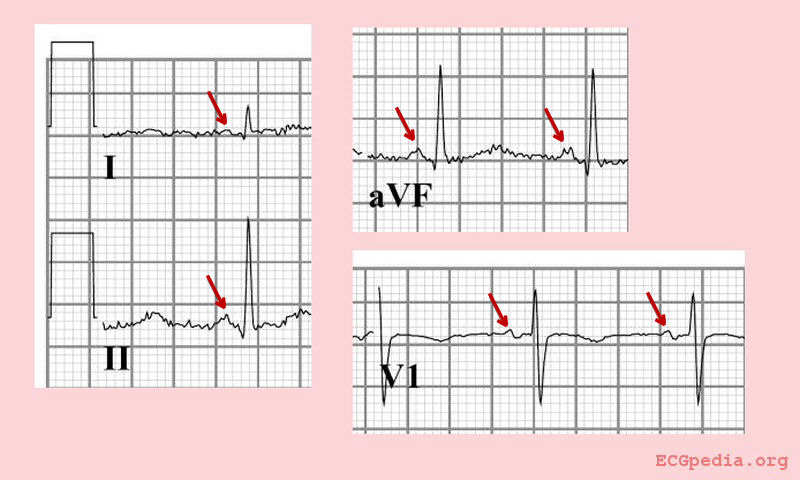 Normal sinus rhythm with a positive p wave in leads I, II and aVF and a biphasic P wave in V1.