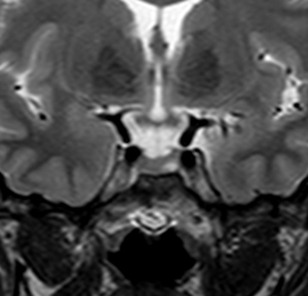 Pituitary microadenoma on T2.[2]
