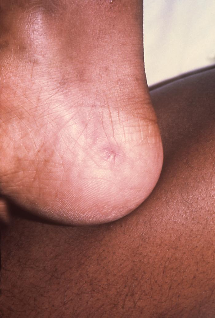 The lesion on this patient’s heel was due to the systemic dissemination of the N. gonorrhoeae bacteria.Gonorrhea is the most frequently reported communicable disease in the U.S. Disseminated gonococcal infection is most often the cause of acute septic arthritis in sexually active adults, and the reason for most hospitalizations due to infective arthritis.