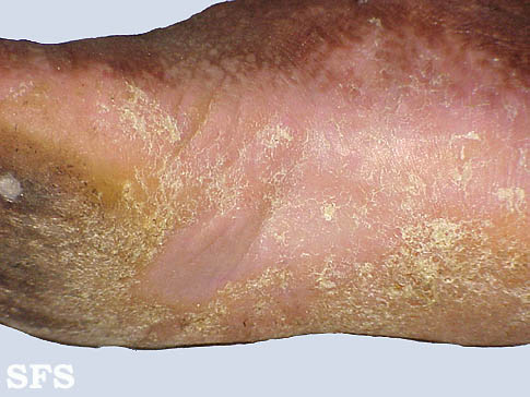 File:Darier's disease26.jpg