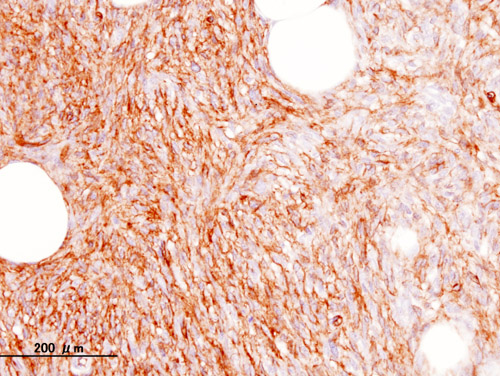 File:Dermatofibrosarcoma protuberans (5) CD34.jpg