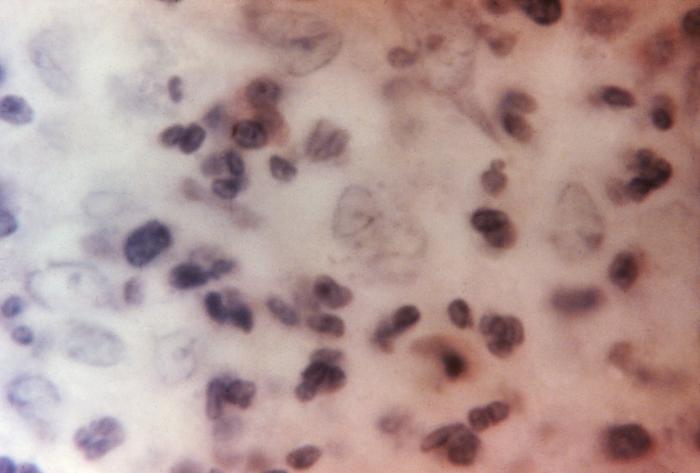 “Donovan bodies” in a tissue sample used to diagnose granuloma inguinale. From Public Health Image Library (PHIL). [1]