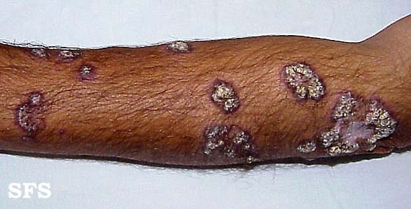 Lupus erythematosus chronicus verrucous. Adapted from Dermatology Atlas.[6]