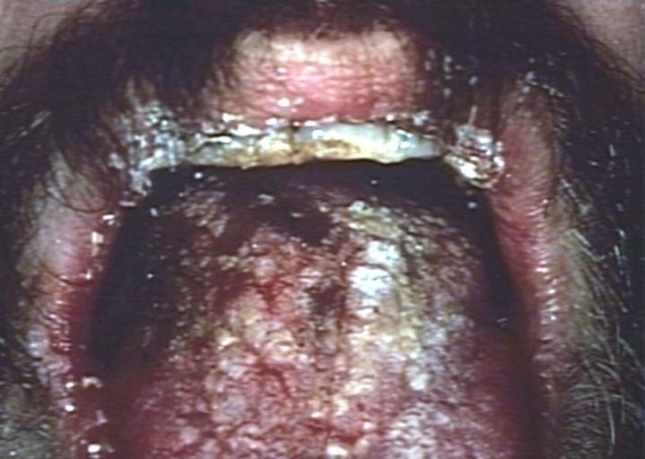 Oral manifestations of HIV infection and AIDS. Chronic oral candidiasis in patient with AIDS. Image courtesy of Professor Peter Anderson DVM PhD and published with permission. © PEIR, University of Alabama at Birmingham, Department of Pathology