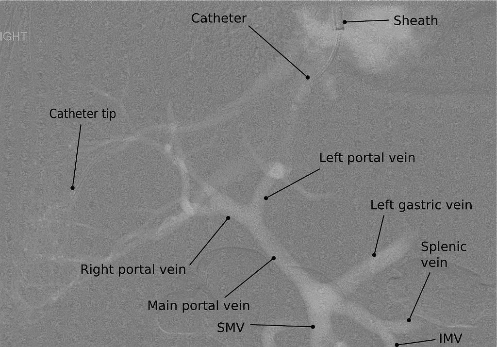 File:Portal-vein-anatomy.jpg
