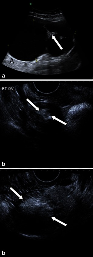 File:Struma ovarii - Scintigraphy 3.jpg