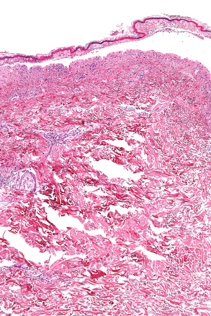 Histology of confluent epidermal necrosis (low mag)Source:By Nephron - Own work, CC BY-SA 3.0, https://commons.wikimedia.org/w/index.php?curid=16874054[10]
