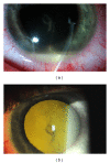 Hypopyon with fibrin (a) and retroillumination demonstrating dense vitreous opacities (b)[22]