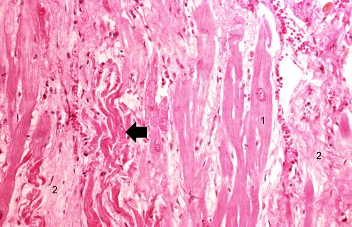 This is another high-power photomicrograph of a healed myocardial infarction. Note the remaining normal myocytes (1), the fibrous connective tissue (2), and occasional hypereosinophilic myocytes indicating recent acute ischemic injury (arrow).