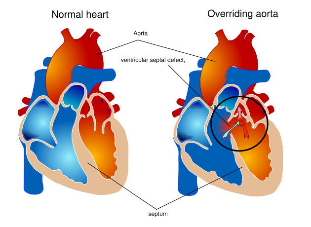 Overriding aorta diagram.svg