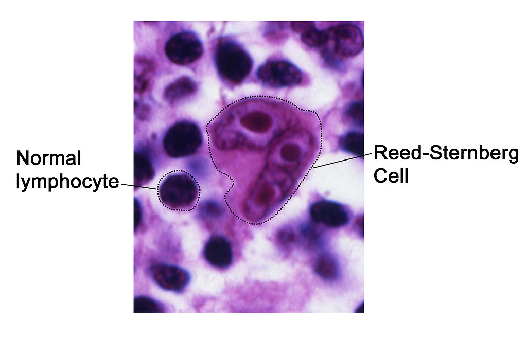 File:Reed-Sternberg lymphocyte.jpg