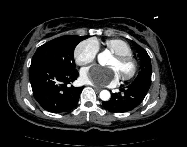 Cardiac Rhabdomyosarcoma Image courtesy of RadsWiki and copylefted