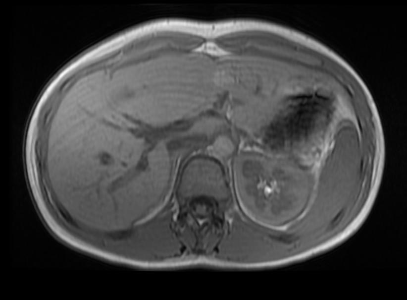 File:Hepatic ademona MRI 006.jpg