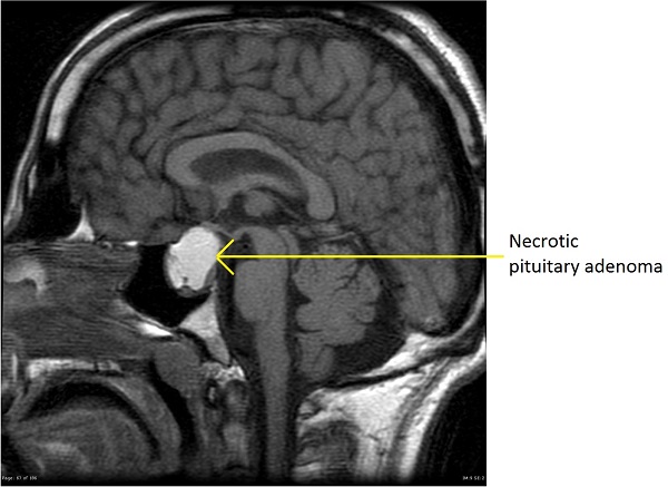 File:Pituitary-macroadenoma-necrotic-1marked reduced.jpg