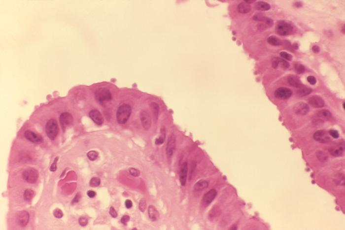 Cryptosporidiosis of gallbladder in AIDS. From Public Health Image Library (PHIL). [1]