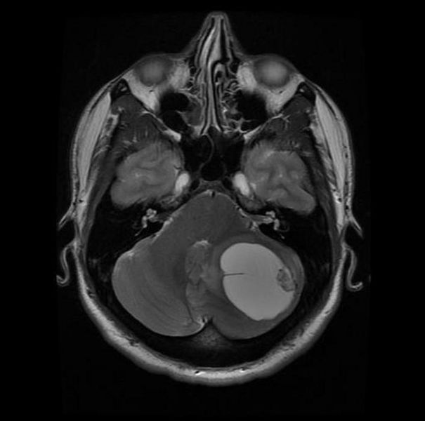 File:Hemangioblastoma-003.jpg