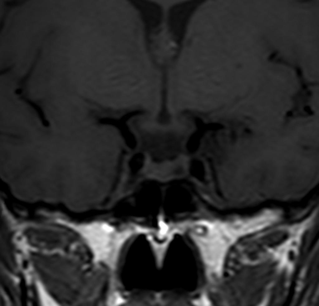 Pituitary microadenoma on T1.[3]