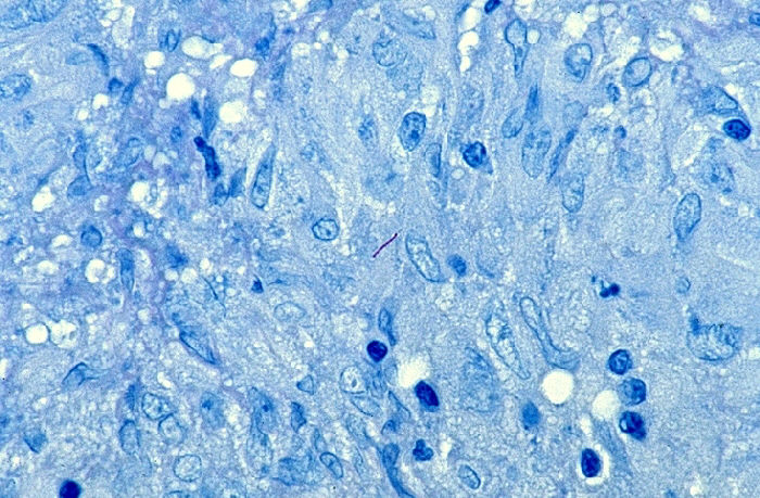 Histopathology of tuberculosis, endometrium. Ziehl-Neelsen stain.Adapted from Public Health Image Library (PHIL), Centers for Disease Control and Prevention.[23]