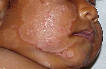 Atopic Dermatitis. Adapted from Dermatology Atlas.<ref name="Dermatology Atlas">{{Cite