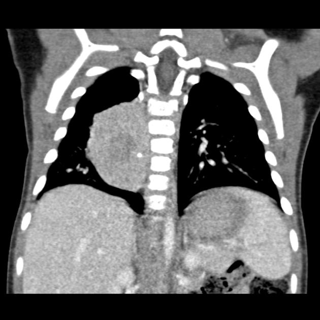 Neuroblastoma observed as a large right enhancing mass with central hypoattenuation on coronal thoracic CT scan[3]