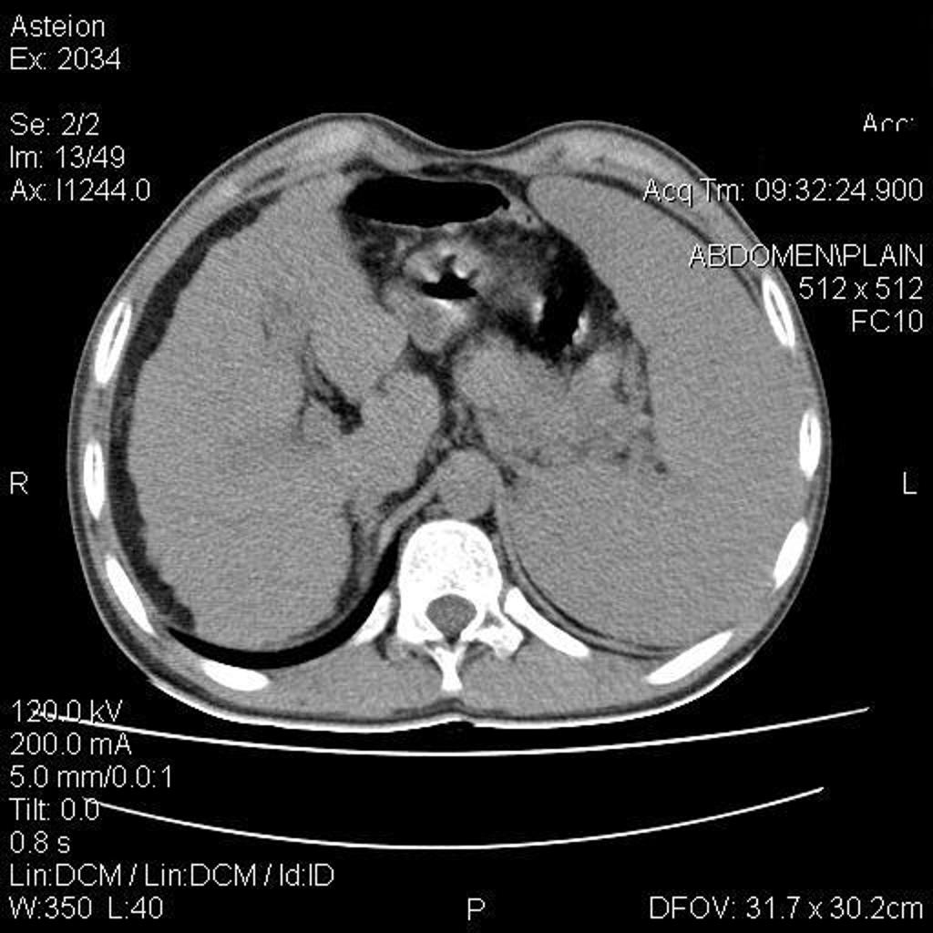 File:Cirrhotic-liver-in-wilson-disease.jpg