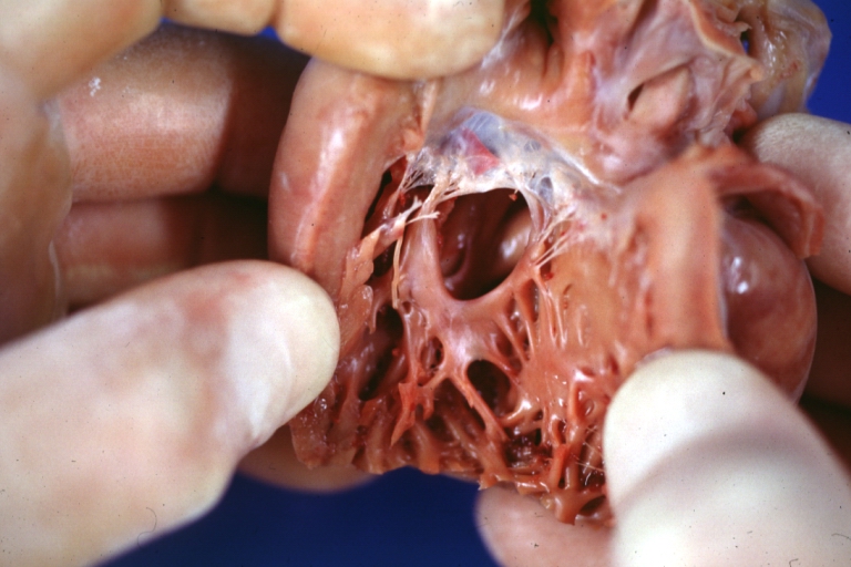 Truncus Arteriosus with Subvalvular Interventricular Septal Defect: Gross, natural color, defect is shown from the right side (view toward right ventricular outlet)