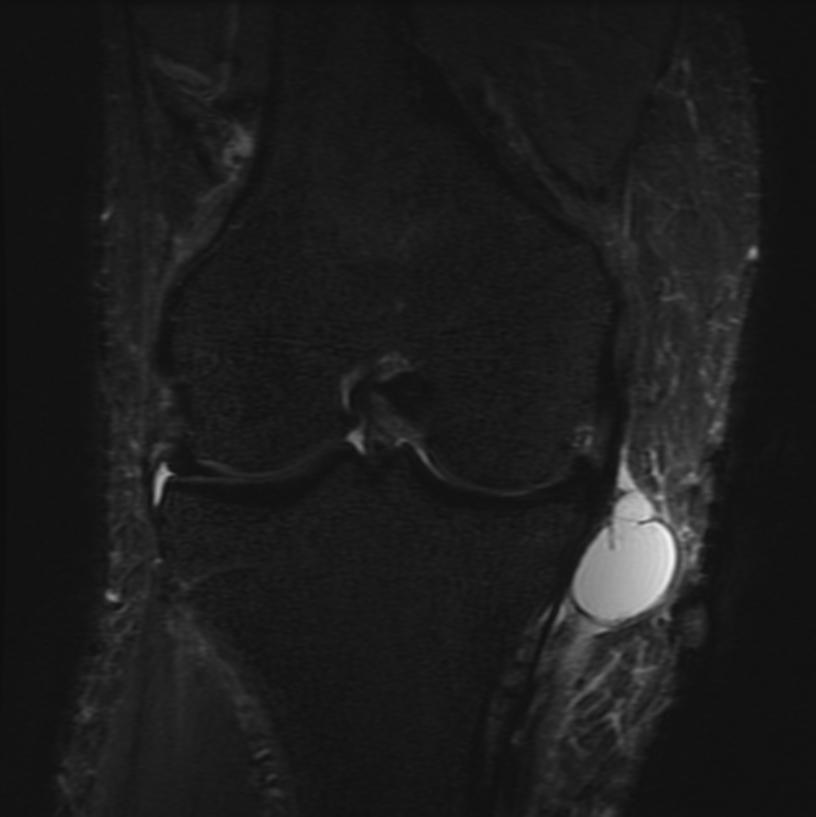 File:Parameniscal cyst MRI 002.jpg