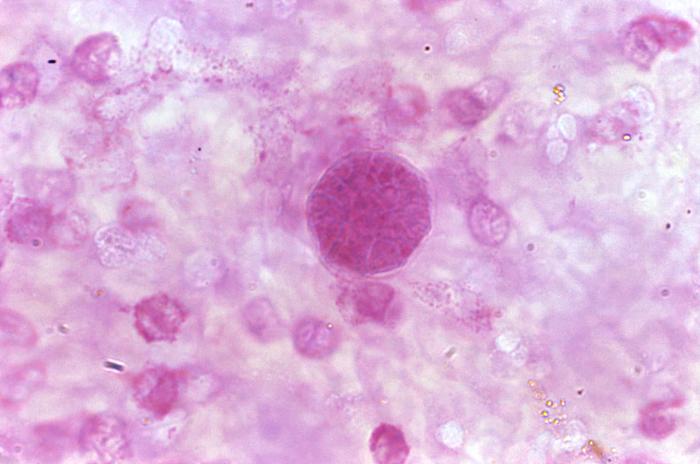 Histopathologic characteristics found within a pus specimen, prepared using periodic acid-Schiff (PAS). Specimen harvested from a skin lesion in a case of cutaneous coccidioidomycosis. From Public Health Image Library (PHIL). [1]
