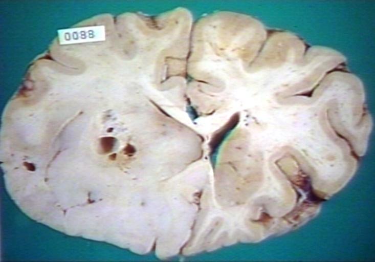 Brain: Oligodendroglioma, Frontal Lobe