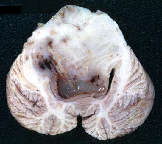 Brain: Glioma: Gross; fixed tissue, horizontal section brain stem and cerebellum with obvious gelatinous appearing neoplasm a pontine glioma