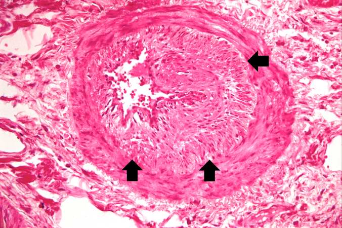 This high-power photomicrograph shows intimal changes (arrows) in this blood vessel in the lung.