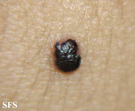 Solitary angiokeratoma. Adapted from Dermatology Atlas.<ref name="Dermatology Atlas">{{Cite