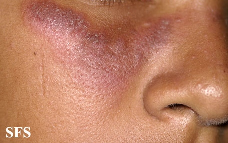 Systemic lupus erythematosus. Adapted from Dermatology Atlas.[6]