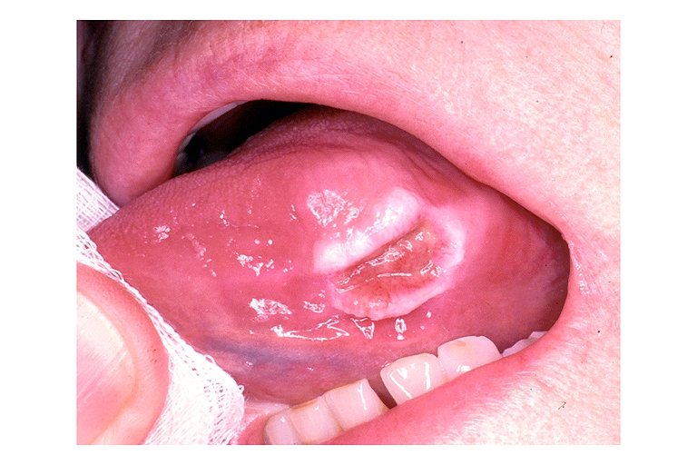 File:Traumatic ulcer oral 001.jpg