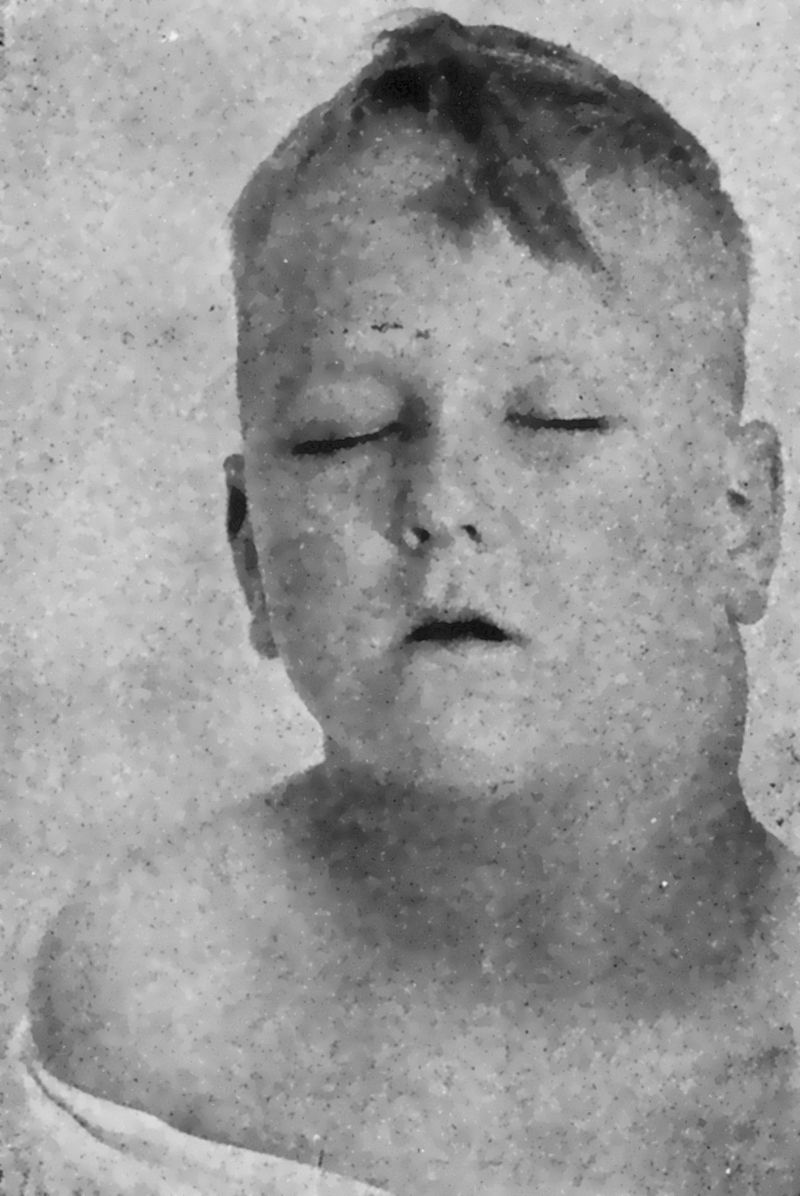 Photograph from a 1938 medical textbook labeled "Hodgkin's Disease".