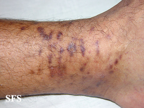 Kaposi's sarcoma. Adapted from Dermatology Atlas.[2]