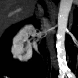 File:Renal artery stenosis 030.jpg