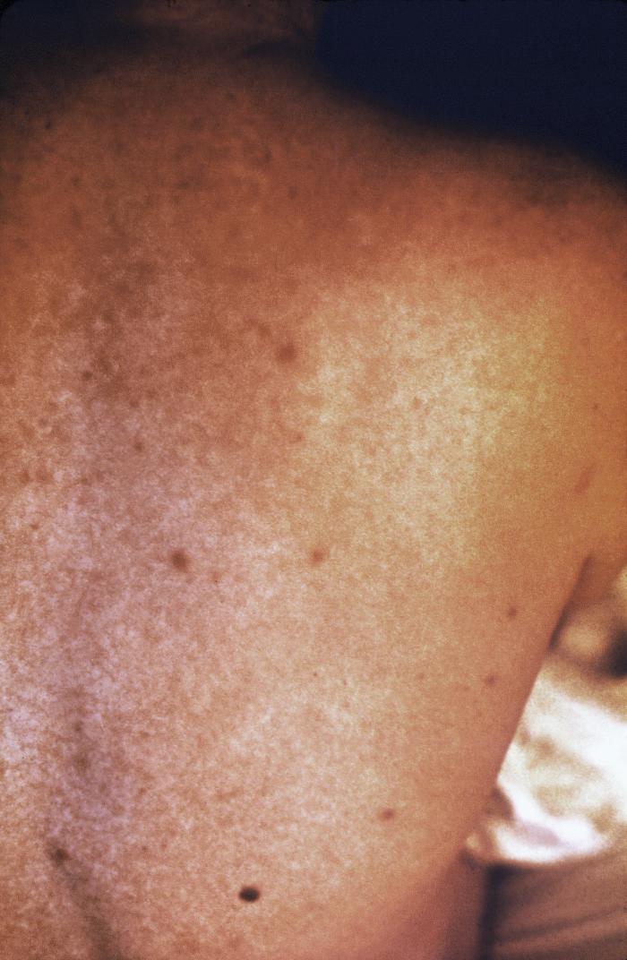 Back of a smallpox patient, who’d presented with a case of vaccine-modified smallpox.Adapted from Public Health Image Library (PHIL), Centers for Disease Control and Prevention.[3]