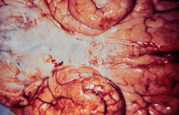 Brain infected with Gram-negative Haemophilus influenzae bacteria From Public Health Image Library (PHIL). [9]