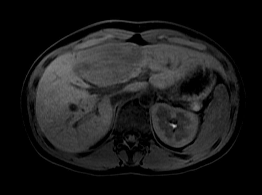 T1 fat sat: A patient with multiple adenoma