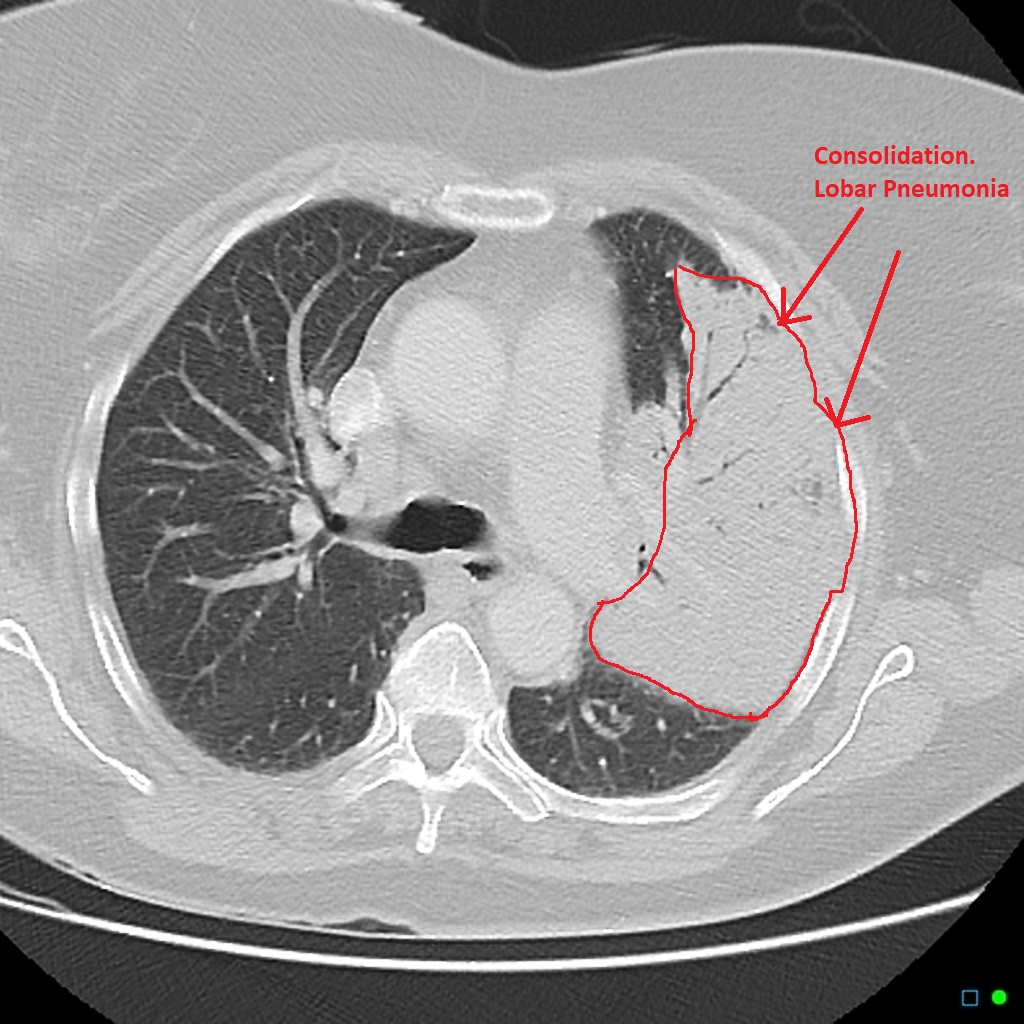 File:Lobar-pneumonia-ct-findings.jpg